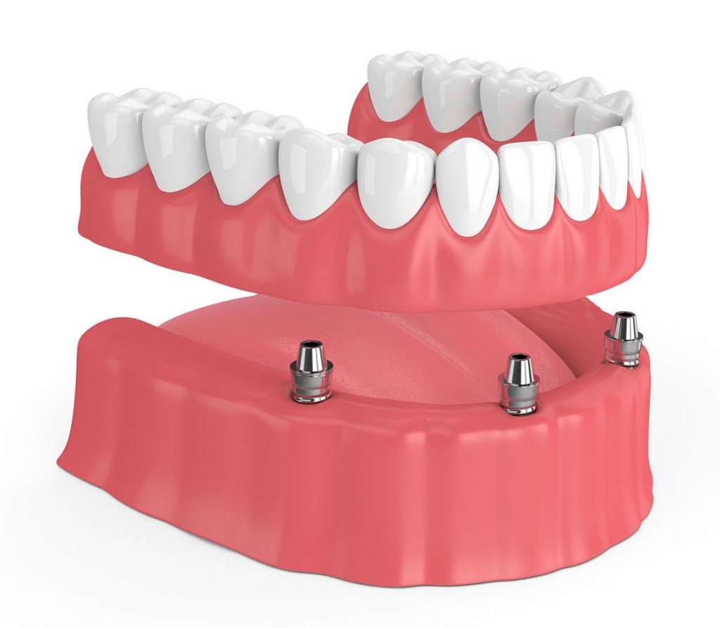 3 - Dentes parafusados a prótese